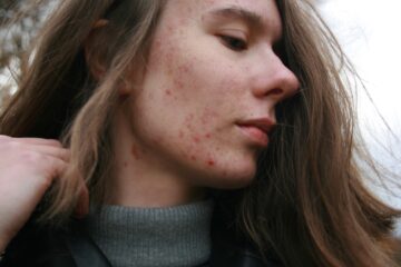 Close-up of acne-prone skin showing breakouts and irritation