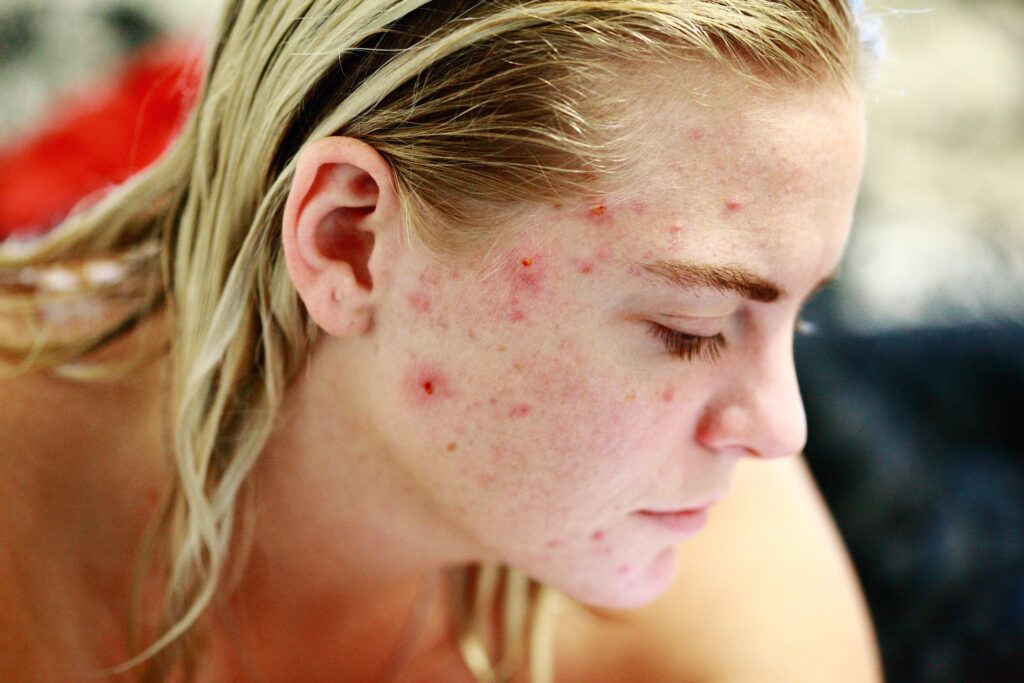 Acne: Causes, Types, and Science-Backed Treatments